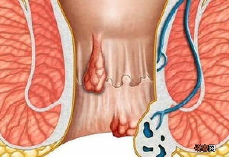 怎么让痔疮肉球缩回去