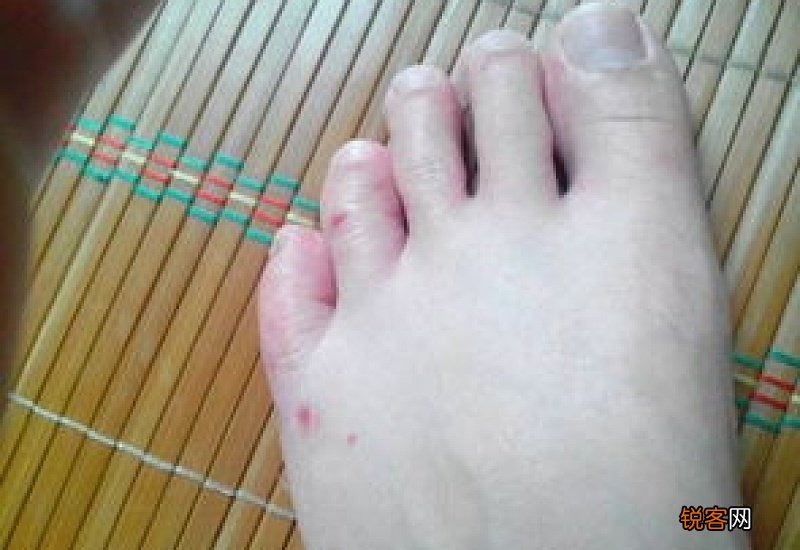 有脚气的鞋放一年了还传染吗