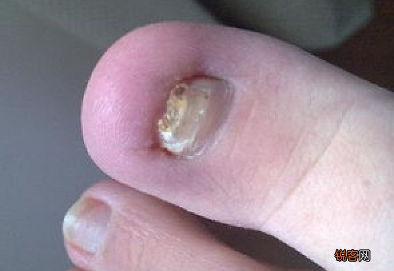 脚趾甲快掉了可以拔吗