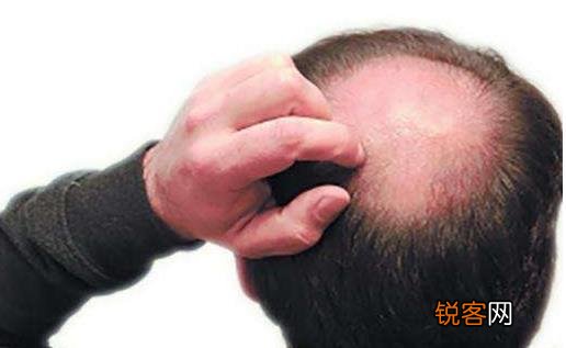 男性脱发能根治吗 男性治脱发易犯的8大误区