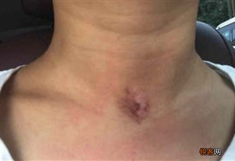 三伏贴为什么起泡发痒