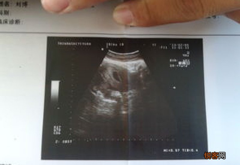 做b超喝撑了也没有尿怎么办