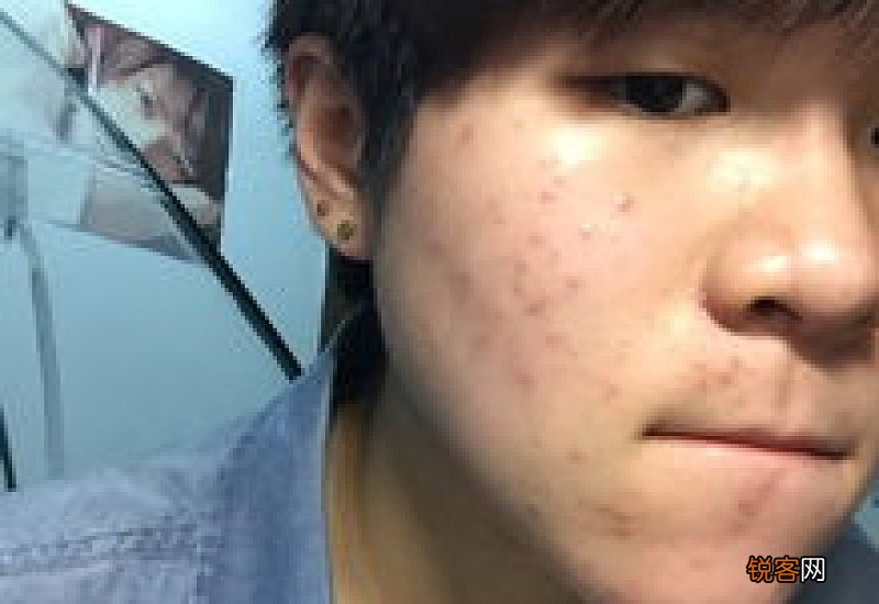 用艾草熏脸可以祛痘吗