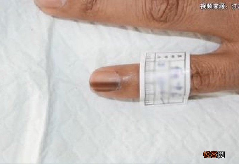 甲黑线和甲母痣的区别