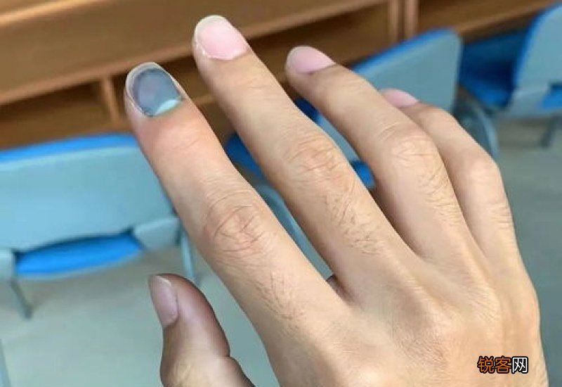 手指被门夹了怎么处理