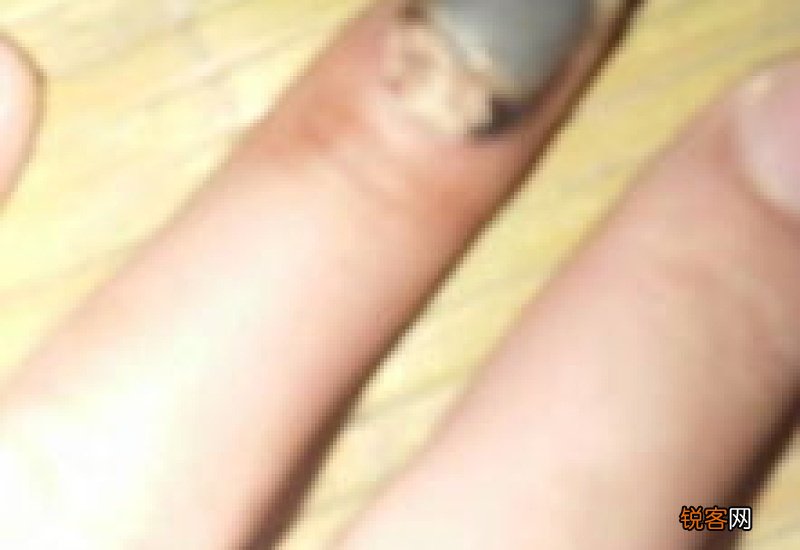 手被车门夹了多久恢复