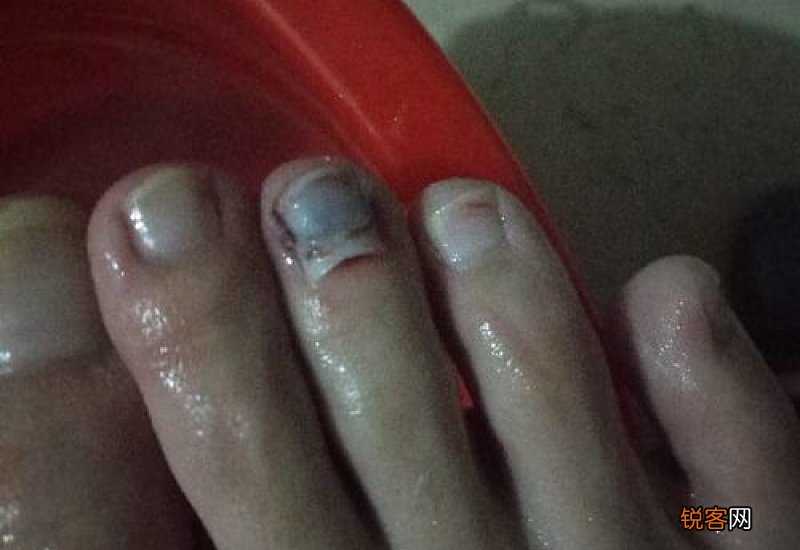 脚趾甲盖被砸掉了要多久好