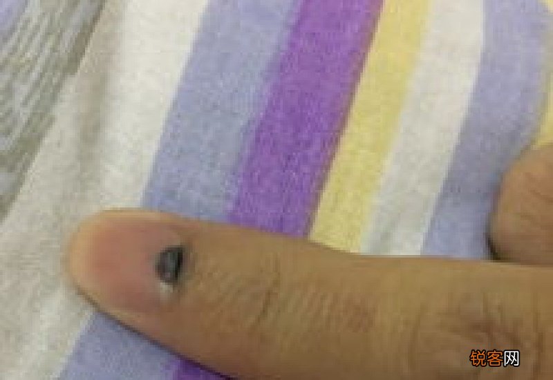 指甲盖有淤血会消失吗