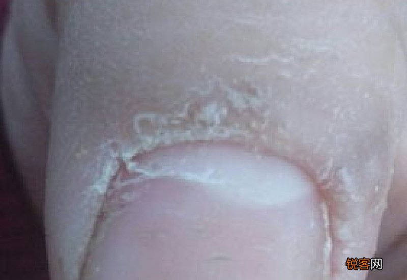 指甲盖和下面的肉分开了怎么办