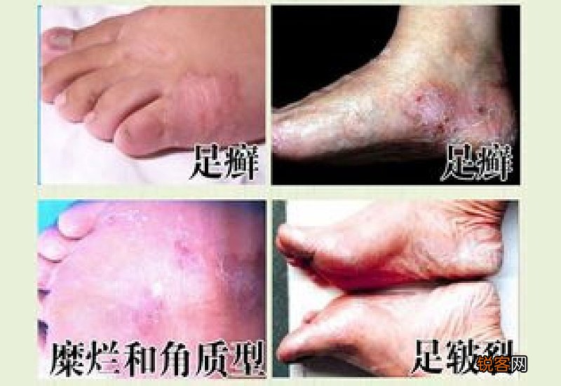 脚气的真菌会粘在被子上吗