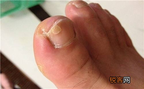 灰指甲能治好吗？灰指甲的医治方式都有什么