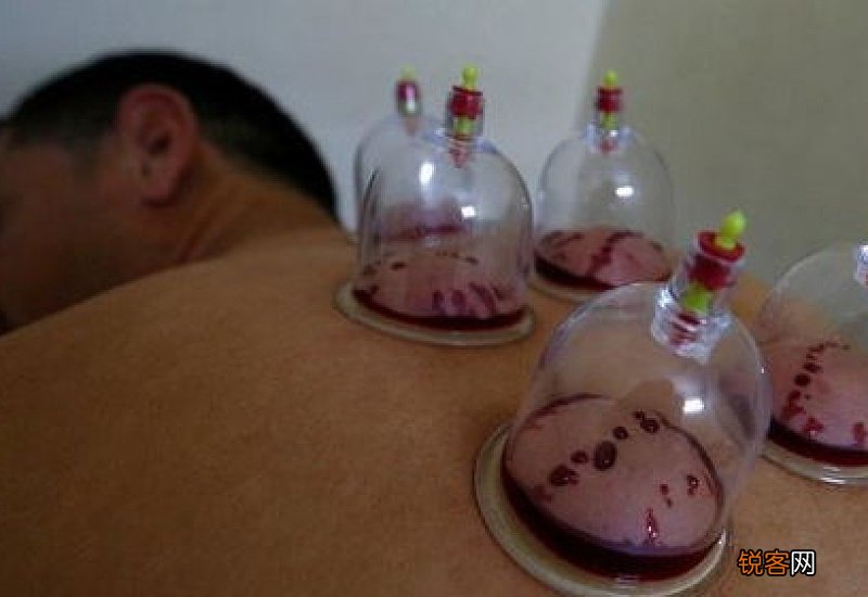 拔完罐黑紫是湿气重吗