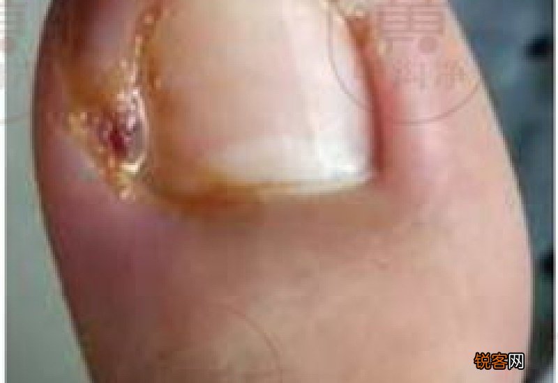 修脚会修成甲沟炎吗