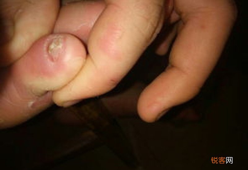 脚趾甲空了一半还能长出来吗