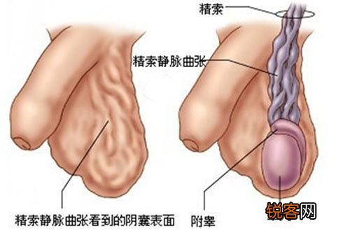 精索静脉曲张晚期有哪些症状 初期认清症状很关键