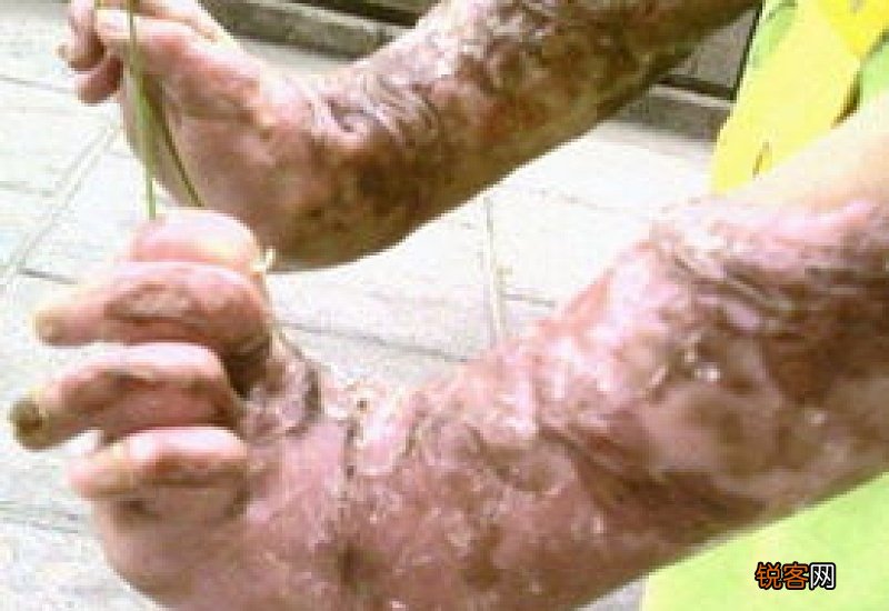 胳膊烫伤还能当兵吗