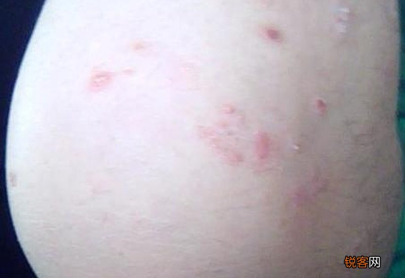 橘皮状早期图片真实