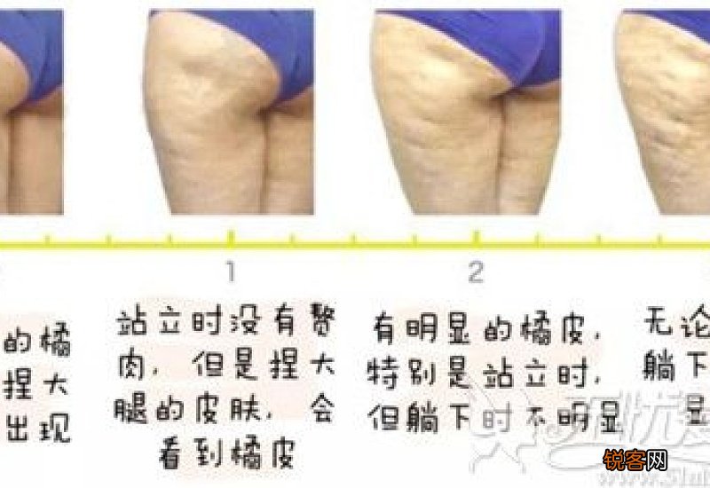 橘皮组织怎么消除