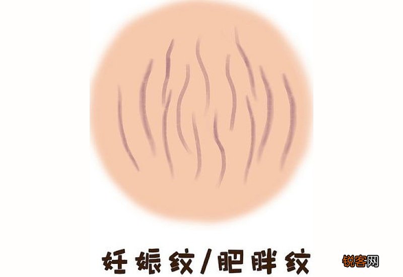 肥胖纹一辈子都去不掉吗