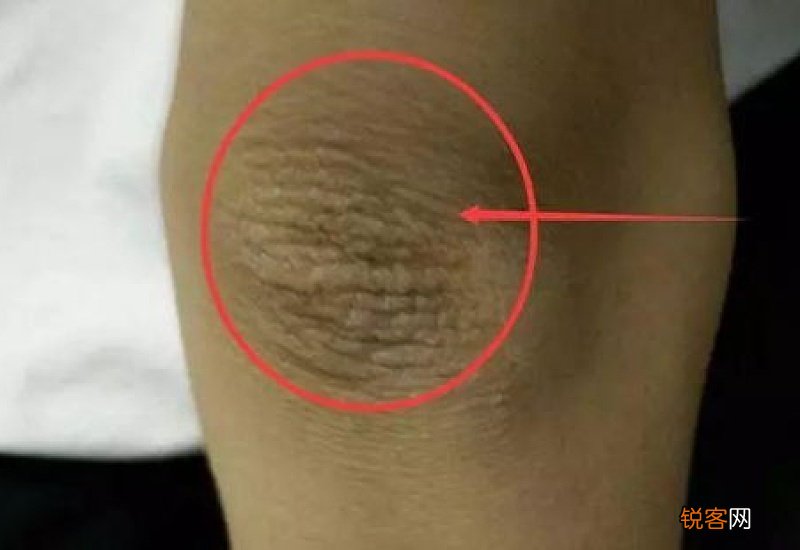 胳膊肘黑粗糙怎么去除 胳膊肘黑而且皮肤还很粗糙是怎么造成的