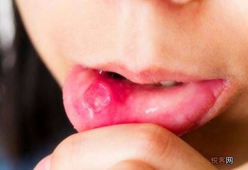 嘴巴上火结痂每天都破怎么办