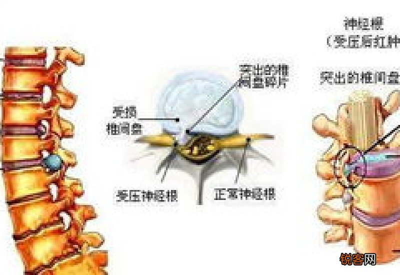 艾草腰椎贴能治腰椎间盘突出吗