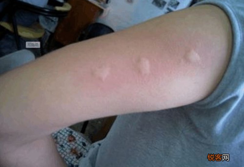 被蚊子咬了可以用酒精消毒吗