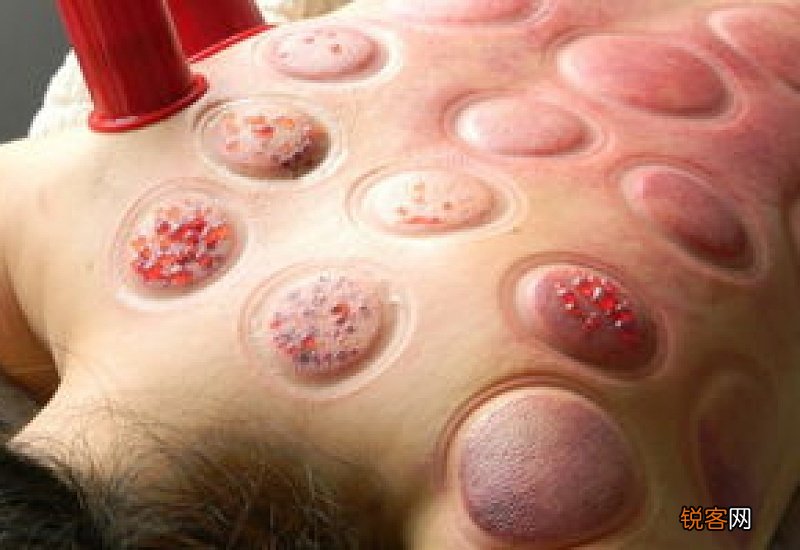 拔罐越黑是湿气越重吗