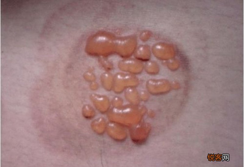 拔罐出水泡可以扎破吗