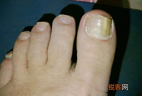 灰指甲的危害你不得不知 灰指甲日常护理办法