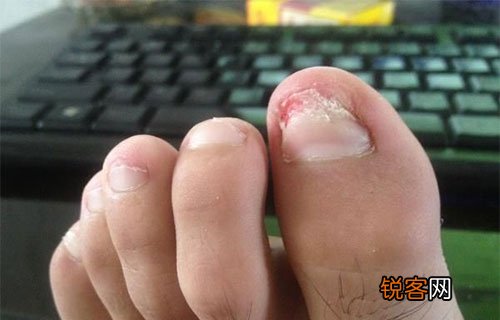 灰指甲的危害你不得不知 灰指甲日常护理办法