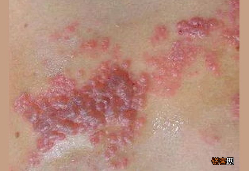 狗狗带状疱疹是什么样的