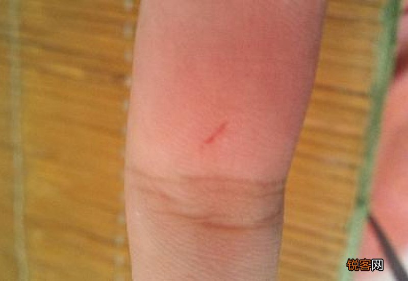 被猫传腹的猫抓伤了